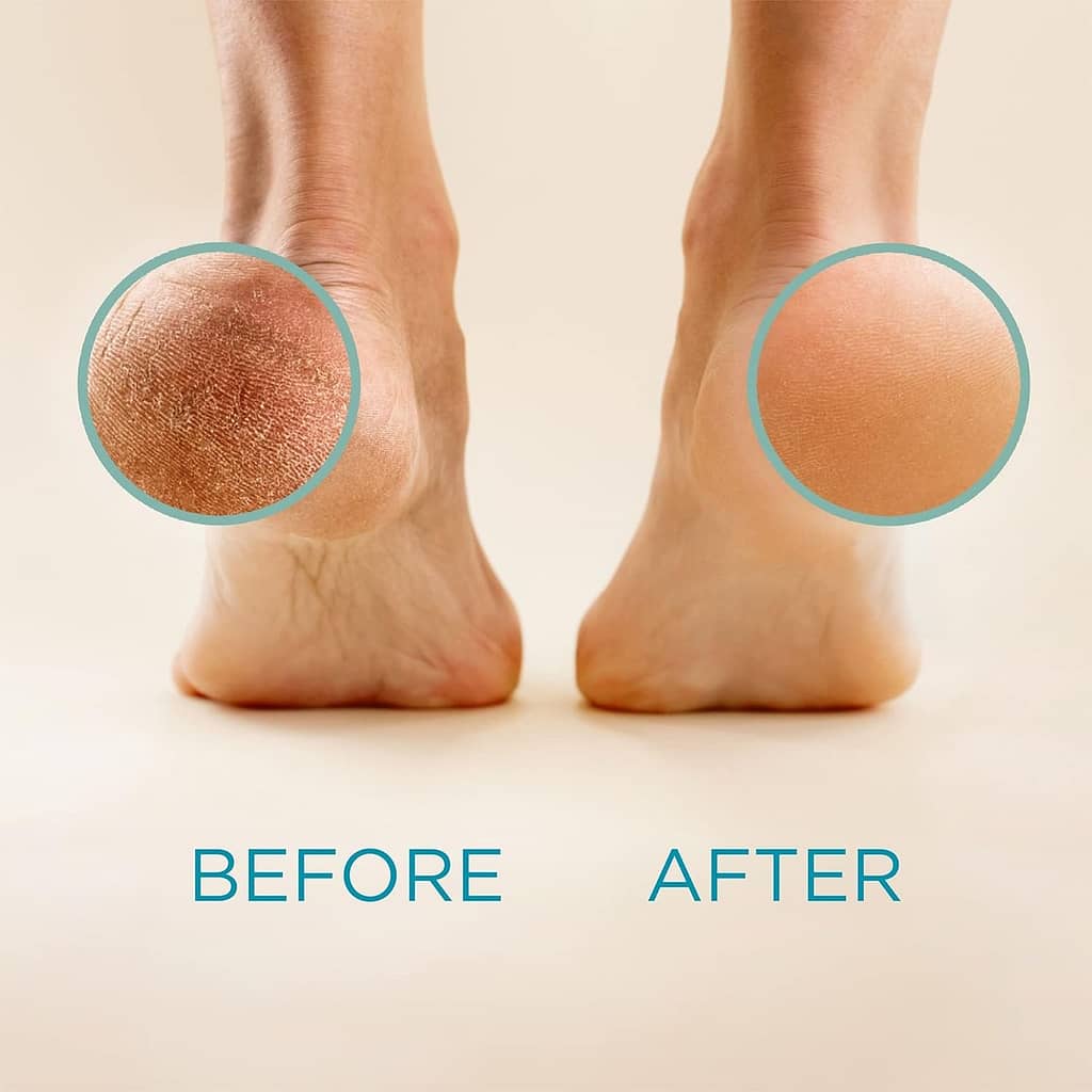 Lee Beauty Professional Callus Remover for Feet - 8 Oz, Original, Powerful Formulation - Extra Strength Gel, Home Pedicure Foot Spa Results - Cracked  Dead Dry Skin Supplies